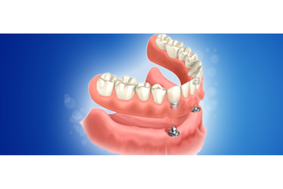 Επιεμφυτευματική οδοντοστοιχία. Εντυπωσιακή  βελτίωση της συγκράτησης σε ολική οδοντοστοιχία στην κάτω γνάθο που 
