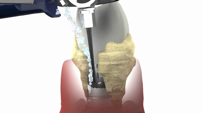 The Vector principle. Διεθνώς παντεταρισμένη τεχνολογία υπερήχων της Γερμανικής Durr Dental για βαθύ καθαρισμό των περιοδοντικών θυλάκων σε συνδυασμό με το Paro Tool kit , ανώδυνα και αποτελεσματικά.   
 

