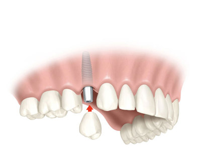 Ακίνητη προσθετική εργασία - Μεμονωμένη στεφάνη με στήριγμα οδοντικό εμφύτευμα.